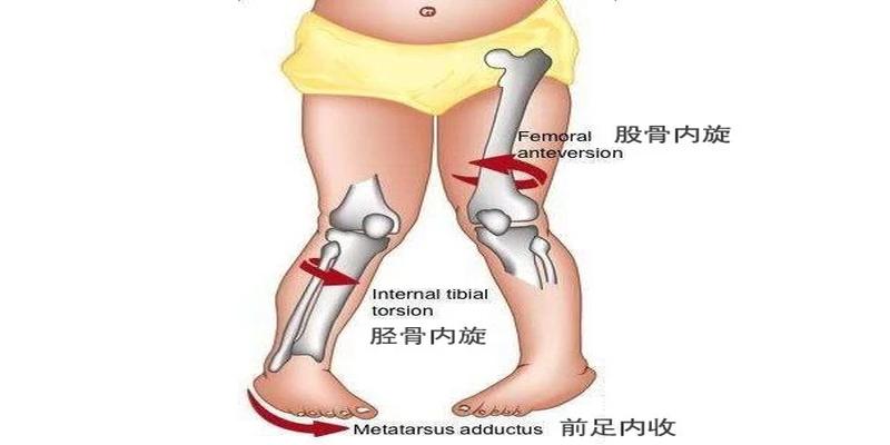 孩子走路内八，鞋子反穿就好？