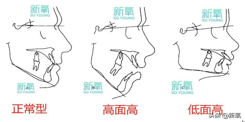 景甜脸咋肿得像个发面馒头？短宽脸都有这个问题