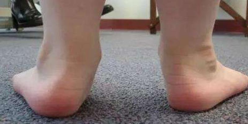 8岁儿童纠正内八字脚(孩子得内八的原因都有哪些)