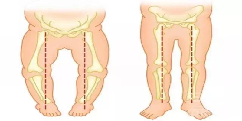 宝宝走路内八字、外八字怎么办，有纠正的方法吗