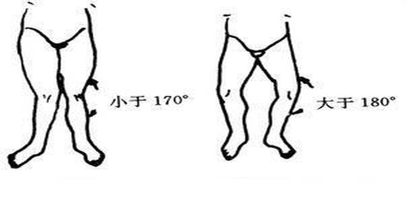 儿童膝内翻与膝外翻需要矫正么？