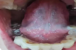 耳鸣时间测吉凶周易(观舌象辨证型)