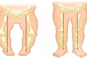2岁宝宝外八字脚如何矫正(宝宝走路内八字)_重复