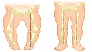 2岁宝宝外八字脚如何矫正(宝宝走路内八字)_重复