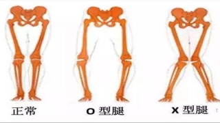 宝宝一岁半走路外八字怎么办(儿童膝内翻与膝外翻需要矫正么)