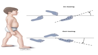 2岁宝宝走路内八字怎么矫正(小孩走路内八字)_重复