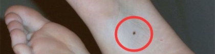 脚底有痣的人多吗?(脚底有痣是什么情况)